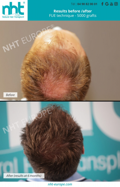Hair-transplant-vertex-before-after-results-5000-grafts-man-hair-density-alopecia-baldness-bald-spot
