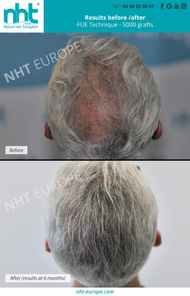 vertex-area-hair-transplant-before-after-results-5000-grafts-fue-dhi-technique-direct-hair-transplant-hairloss-solution-baldness-hairgrowth-long-hair