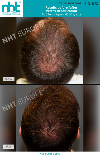 densification-vertex-top-of-the-head-hair-transplant-4500-hair-grafts-before-after-results-baldness-solution-hairloss-alopecia