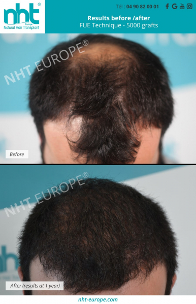 5000-hair-graft-transplantation-vertex-area-head-scalp-fue-dhi-technique-hair-loss-baldness-solution-treatment-before-after-resultats-at-1-year