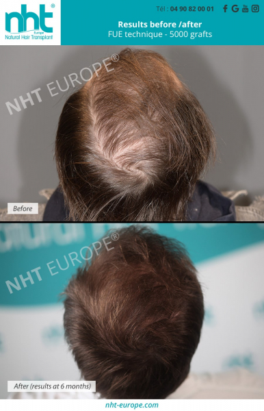 densification-vertex-top-of-the-head-hair-transplant-5000-hair-grafts-before-after-results-baldness-solution-hairloss-alopecia