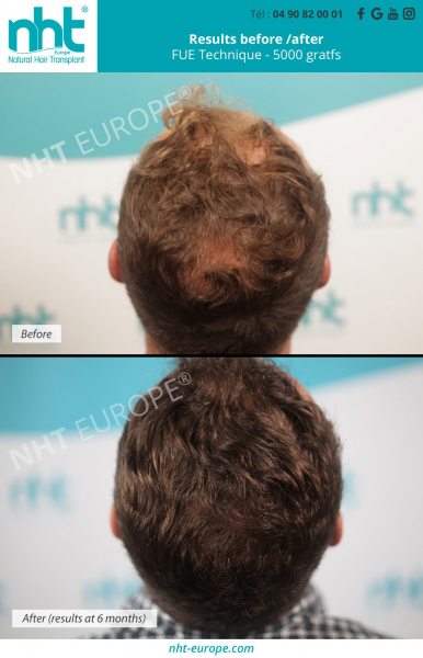 hair-loss-solution-hair-transplant-result-before-after-vertex-france-5000-grafts