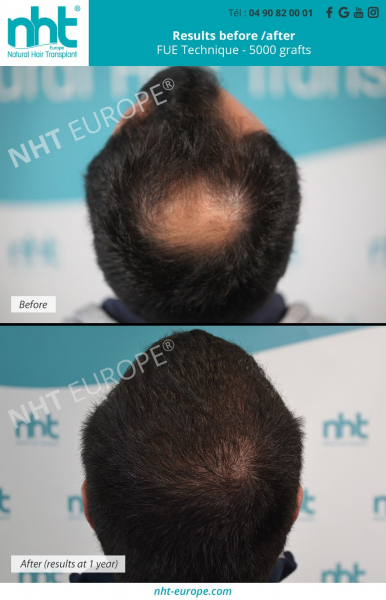 5000-hair-graft-transplantation-vertex-area-head-scalp-fue-dhi-technique-hair-loss-baldness-solution-treatment-before-after-resultats-at-1-year