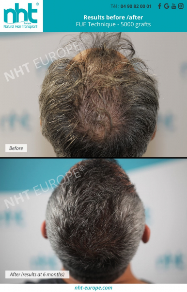 vertex-hair-transplant-before-after-results-5000-grafts-at-6-months-hair-growth-baldness-surgery-solution-best-clinic-france-avignon
