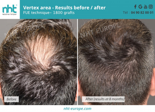 vertex-area-hair-transplantation-results-before-after-1800-grafts