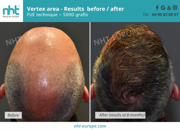 hair-transplant-vertex-area-results-before-after-fue-technique-5000-grafts