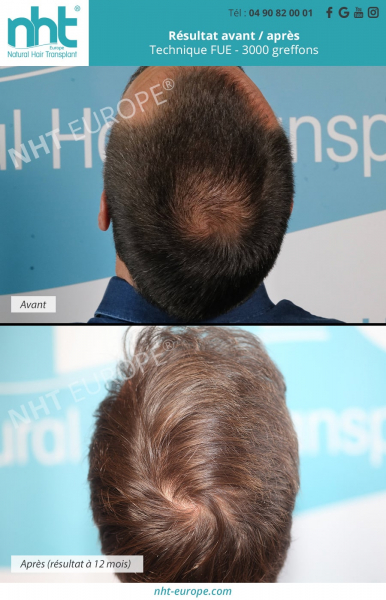 greffe de cheveux tonsure vertex resultat avant apres