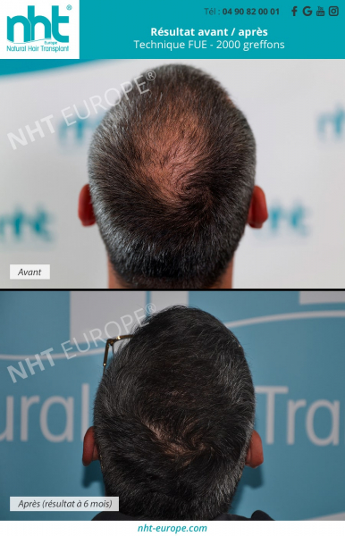 greffe-de-cheveux-vertex-2000-greffons-technique-fue-dhi-arriere-de-la-tete-tonsure