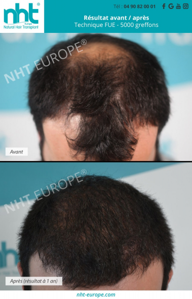 greffe-de-cheveux-vertex-5000-greffons-clinique-france-nht-avignon-marseille-montpellier-nice-lyon-grenoble-paris-evolution-resultat-à-1-an