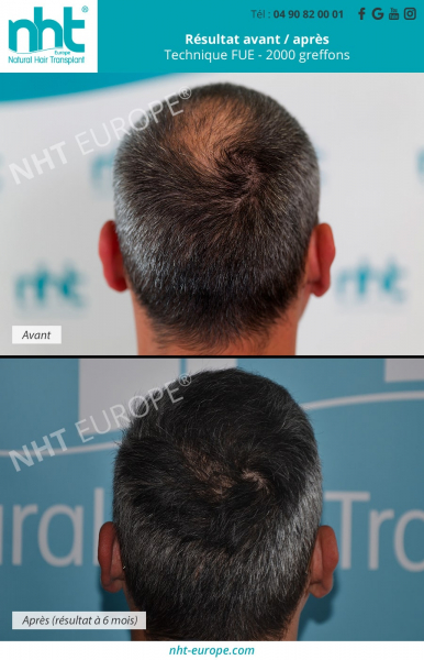 greffe-de-cheveux-vertex-2000-greffons-technique-fue-dhi-arriere-de-la-tete-tonsure-zone-donneuse