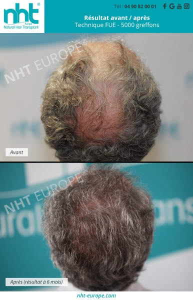 Greffe-de-cheveux-arriere-du-crane-sommet-du-crane-implant-capillaire-alopecie-chute-de-cheveux-calvitie-homme-solution-repousse-resultat-6-mois-post-operatoire-vaucluse-vertex-tonsure