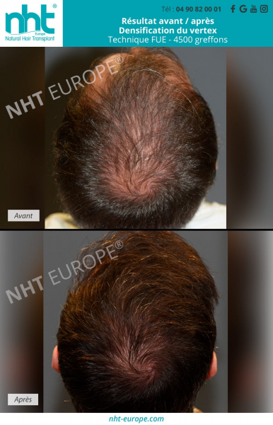 greffe-de-cheveux-sur-la-zone-du-vertex-densification-tonsure-4500-greffons-arrière-du-crane-cheveux