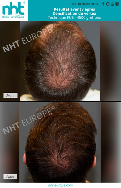 greffe de cheveux sur la zone du vertex densification tonsure 4500 greffons arrière du crane cheveux