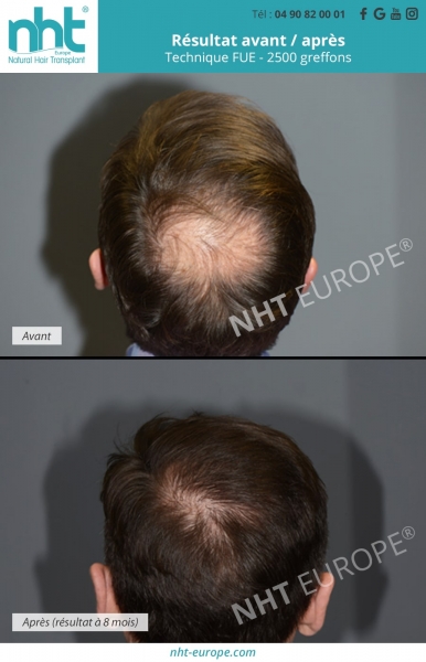 greffe de cheveux zone vertex resultat avant apres 2500 greffons homme calvitie