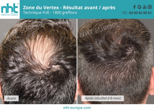 redensification des cheveux arriere du crane apres une greffe capillaire de 1800 greffons