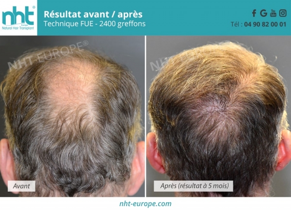 resultat-greffe-cheveux-repousse-zone-vertex-de-2400-greffons-5-mois-post-operatoire