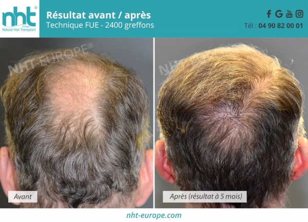 resultat greffe cheveux repousse zone vertex de 2400 greffons 5 mois post operatoire