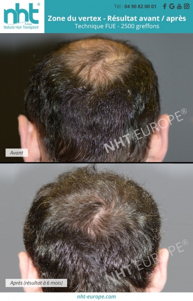 implant capillaire zone du vertex 2500 greffons resultat a 6 mois
