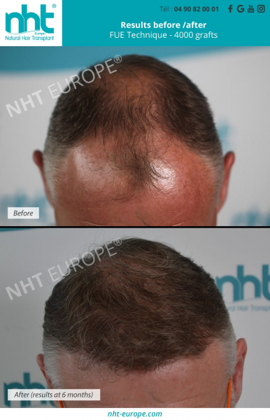 top-of-the-head-hair-transplant-4000-grafts-before-after-results-at-6-months