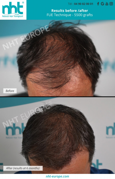 natural-hair-transplant-5500-grafts-man-hairloss-solution