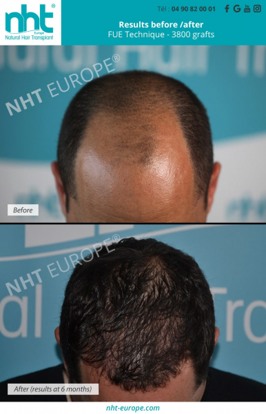 before after hair transplant top of the head megasession