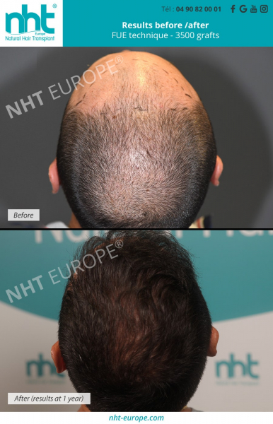 top-of-the-head-hair-transplant-3500-hair-grafts-fue-technique