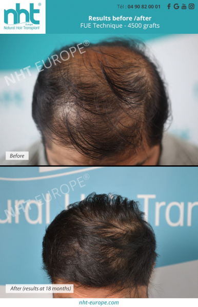 hairtransplantation 4500 grafts before after results 18 months post operative