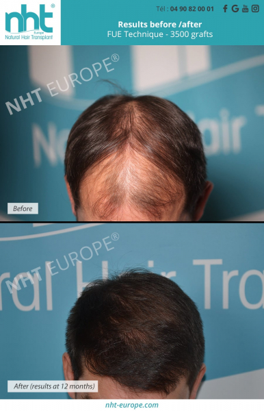 top of the head hairtransplant 3500 grafts hairtransplant nht europe