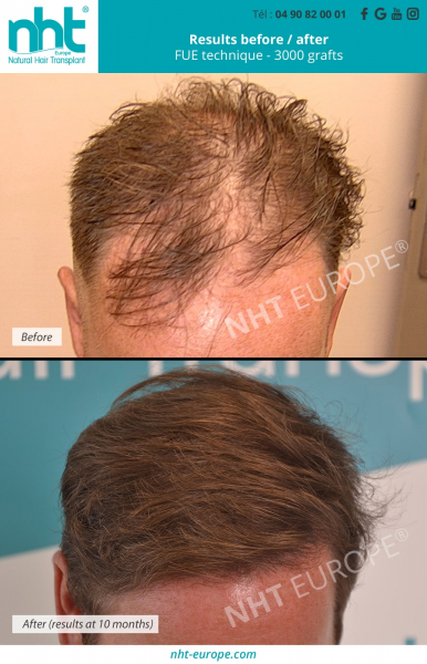 top-of-the-head-hair-transplant-before-after-results-at-1-year-with-3000-grafts-baldness-solution-hairloss-clinic-in-france