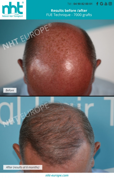 hair transplant grey hair fue technique dhi before after