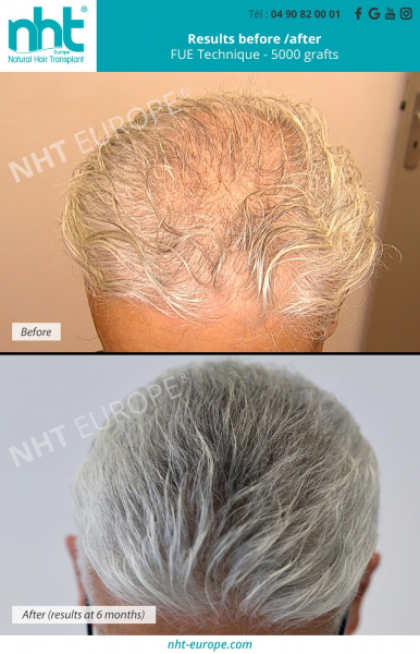 middle-scalp-top-of-the-head-hair-transplant-hair-grafting-dhi-fue-technique-5000-grafts-mega-session-results-at-6-months-alopecia-bald-solution-france