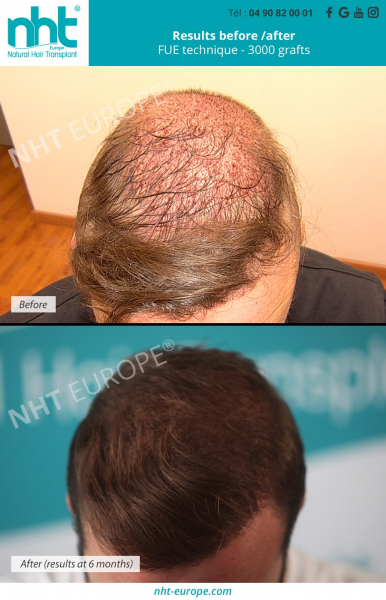 hair-transplant-results-before-after-at-6-months-fue-technique-3000-grafts-alopecia-bald-men-man-hair-line-densification-baldness-solution