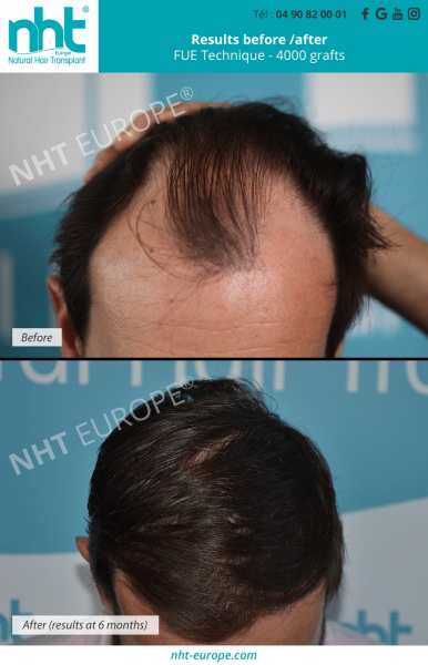 before after hairtransplant 4000 grafts mega session before after results at 6 months