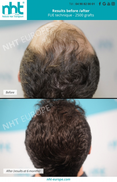 hair-transplant-top-of-th-head-2500-grafts-fue-dhi-technique-hairloss-solution