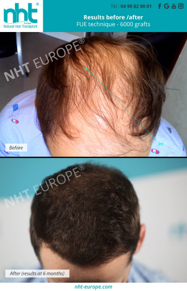 Hair transplantation-implantation-results-after-6-months-6000-graft-technique-fue-doctor-ginouves-density-hair-thickness-centre-nht-europe-avignon-vaucluse-baldness-calopecia-hairloss-bald-spot