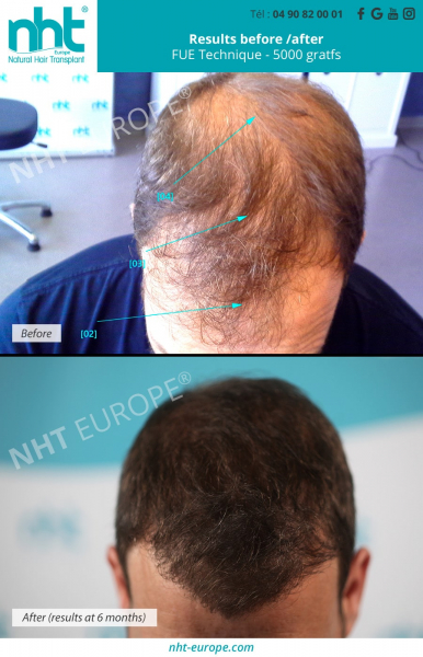 results-top-of-the-head-hair-transplant-5000-grafts-hair-growth-france