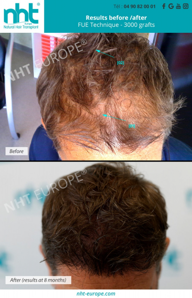 top-of-the-head-hair-transplant-before-after-results-at-8-months-with-3000-grafts-baldness-solution-hairloss-clinic-france