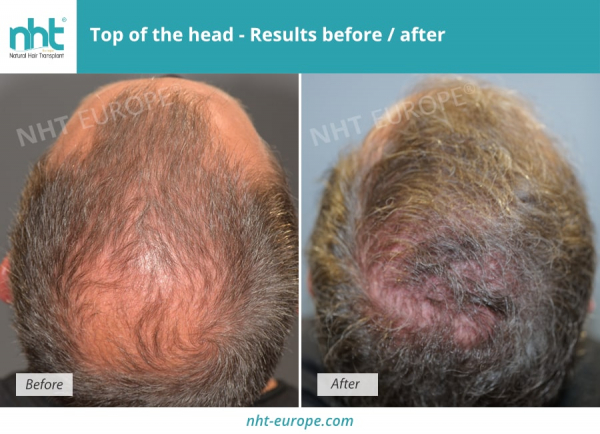 results-before-after-top-of-the-head-hair-grafting