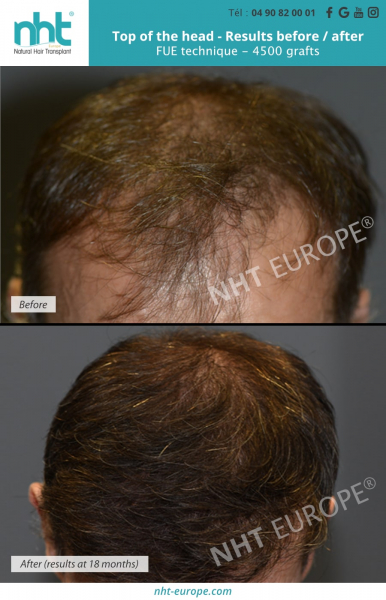 hair-transplant-top-of-the-head-area-results-before-after-4500-grafts-hair-growth
