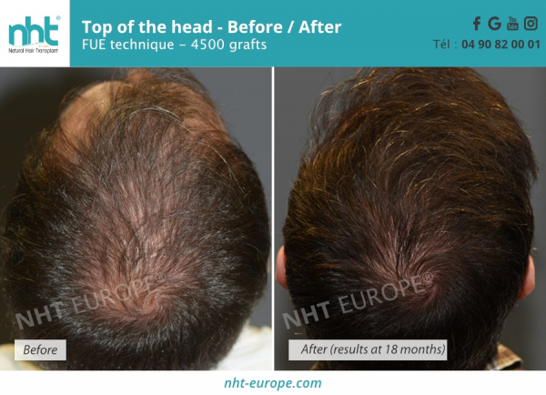 hair-transplants-top-of-the-head-4500-grafts-before-after-results