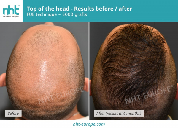 Before/After Results Hair Transplant for Men and Women