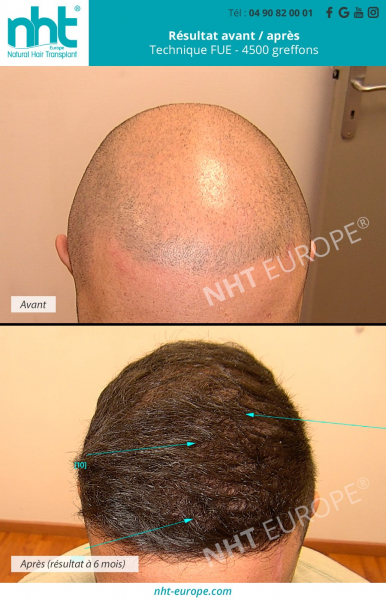 greffe-capillaire-sommet-du-crane-technique-fue-dhi-4500-greffons-resultat-avant-apres-à-6-mois-densification-repousse-cheveux-stimulation-des-cheveux-prp-anesthesie-locale-meilleure-clinique-france-nht-natural-hair-transplant