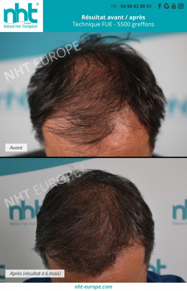 greffe-de-cheveux-homme-5500-greffons-maxi-greffe-sommet-du-crane-ligne-frontale-resultat-avant-apres-6-mois-pousse-des-cheveux-clinique-france-avignon