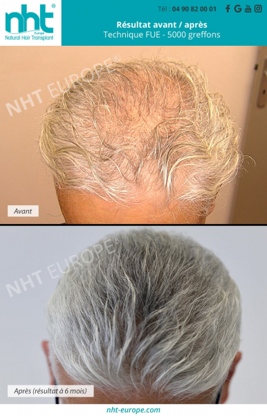 greffe-de-cheveux-implant-capillaire-sur-le-sommet-du-crane-middle-scalp-cheveux-blancs-homme-resultat-avant-apres-à-6-mois-5000-greffons-mega-session-zone-donneuse-technique-fue-dhi-france