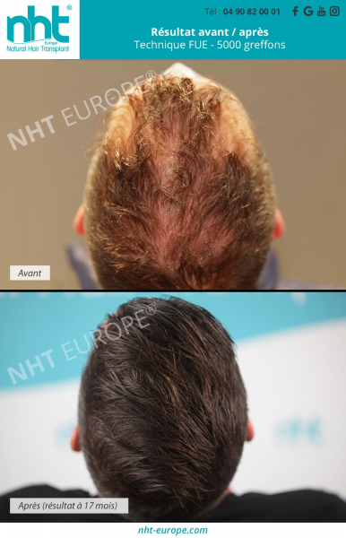 resultat-avant-apres-greffe-de-cheveux-densification-sommet-du-crane-technique-fue-dhi-5000-greffons-calvitie-chute-perte-de-cheveux-solution-homme-meilleure-clinique-implant-capillaire
