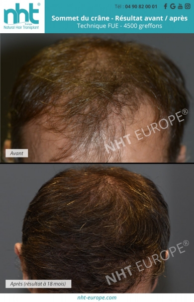 resultat-greffe-cheveux-avant-apres-18-mois-technique-fue