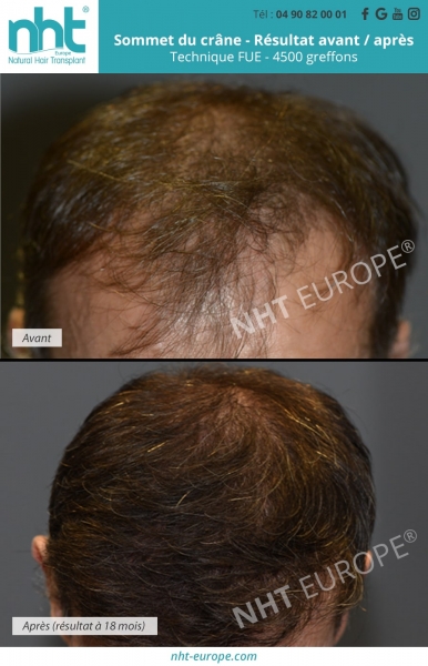 resultat-greffe-cheveux-avant-apres-18-mois-technique-fue