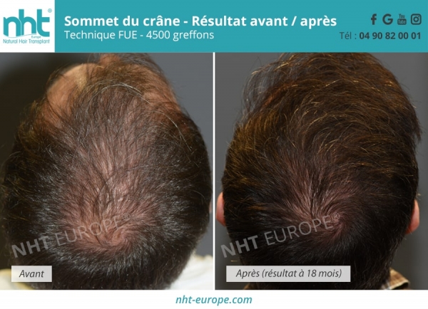 redensification-du-sommet-du-crane-greffe-capillaire-de-4500-greffons-resultat-a-18-mois