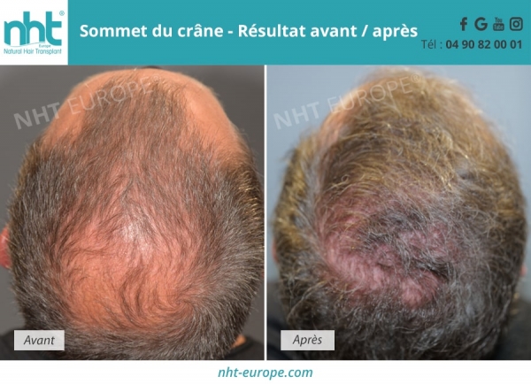 chirurgie-cheveux-sur-le-sommet-du-crane-avant-apres