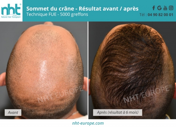 avant-apres-implant-capillaire-tonsure-sommet-du-crane-5000-greffons